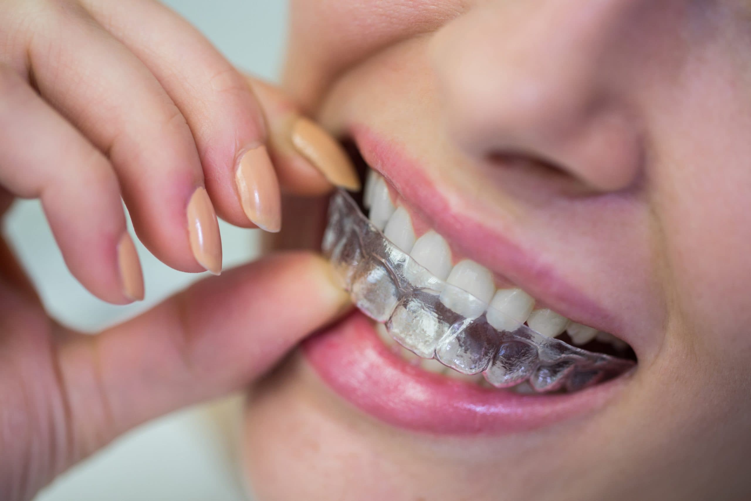 Paciente utilizando un alineador dental transparente